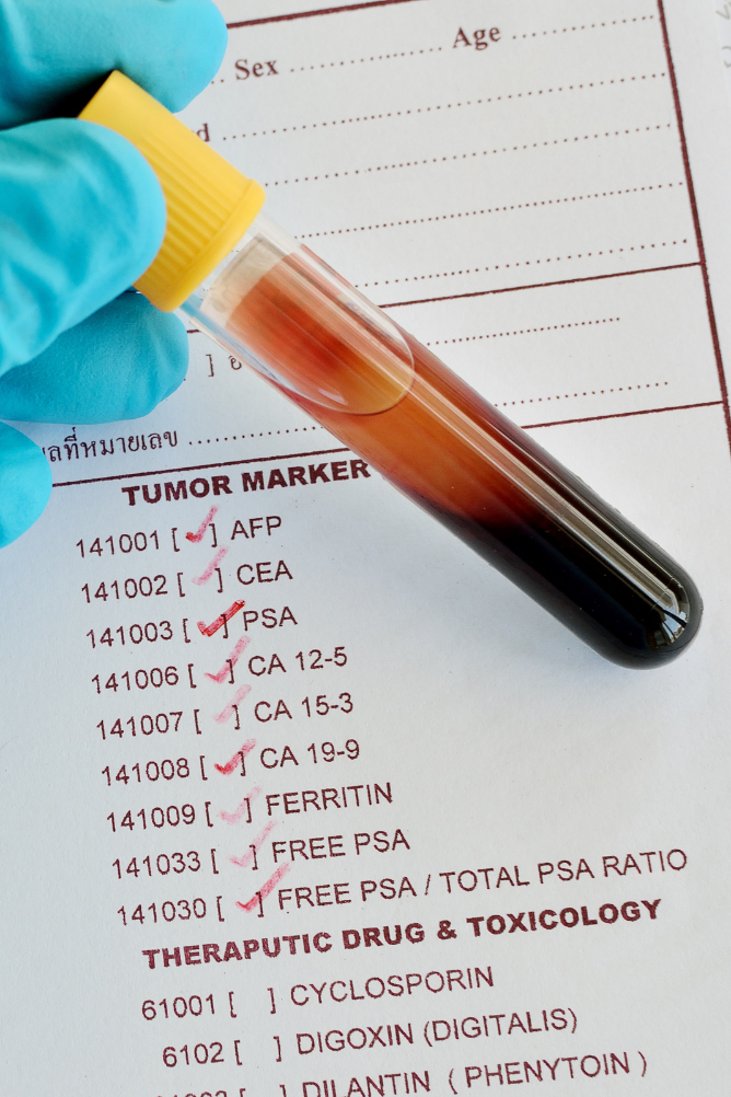 O que você precisa saber sobre o marcador tumoral CA125?
